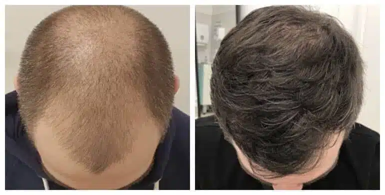Can You Do a Hair Transplant Without Shaving Your Head? Yes, Here's How